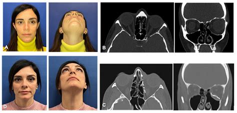 Patient Specific Implants for Orbital Reconstruction in the Treatment of Silent Sinus Syndrome ...