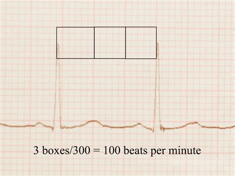 How to Read an EKG: 9 Steps (with Pictures) - wikiHow