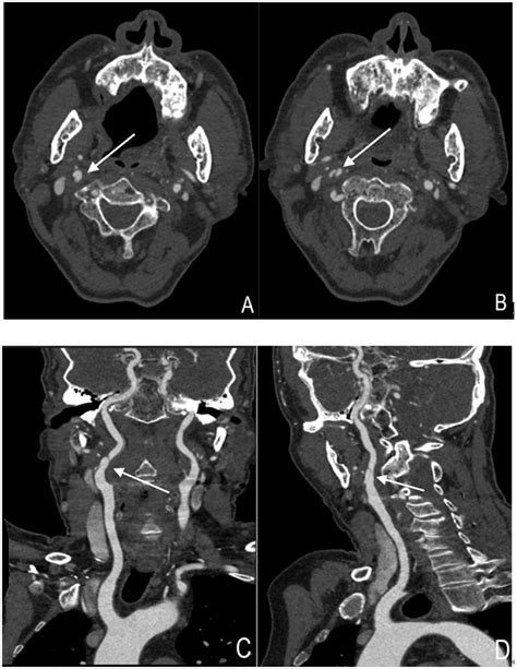 Frontiers | Carotid artery dissection recanalization: imaging ...