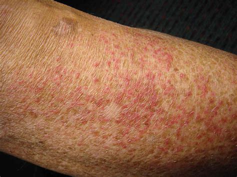 12 Tips to Help Women Manage Inner Thigh Rash