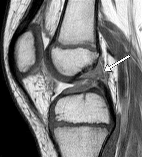 Mri Knee