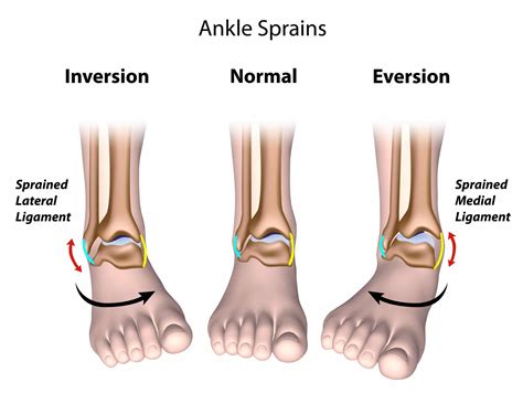 Medial Ankle Sprain