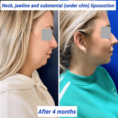 What is the Best Double Chin Treatment? - Harley Clinic