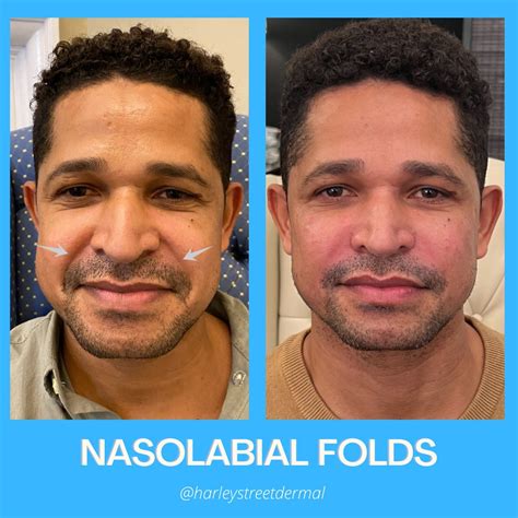 Smile Lines Treatment in London | Harley Street Dermal