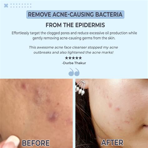 Acne Face Cleanser For Acne Spots & Pigmentation | Teenilicious