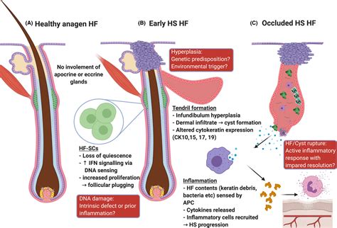 Hidradenitis suppurativa: A folliculotropic disease of innate immune barrier dysfunction ...