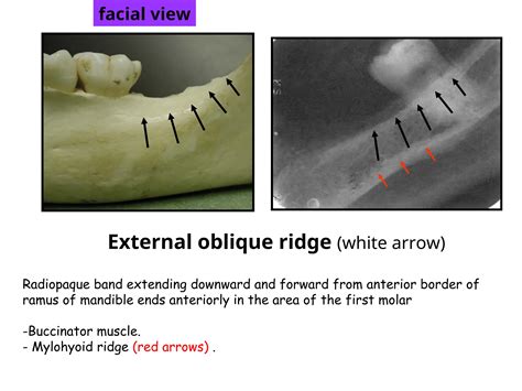 7 Normal Anatomical Landmarks OF MAXIILA AND MANDIBLE.ppt