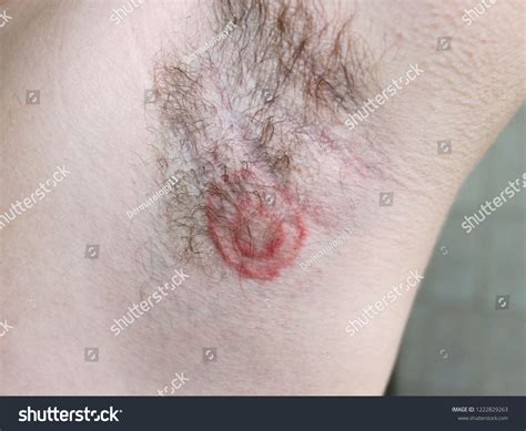 Skin Fungal Infection Tinea Corporis Armpit Stockfoto 1222829263 | Shutterstock