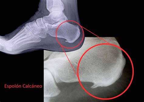 Espolón Calcáneo: Causas, Síntomas y Tratamiento