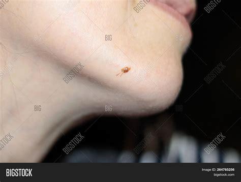 Mole On Face With Hair