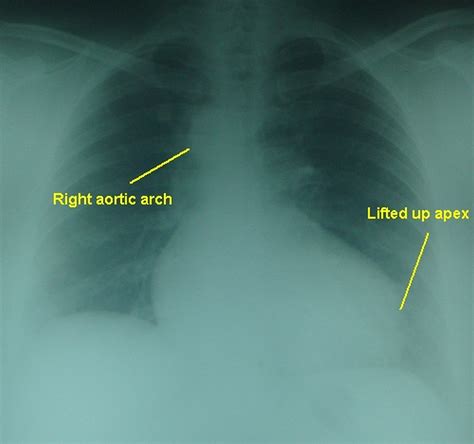 Tetralogy of Fallot – Right aortic arch - X-ray chest PA view