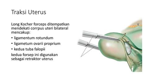 Pendekatan Anatomi pada Radikal Histerektomi.pptx