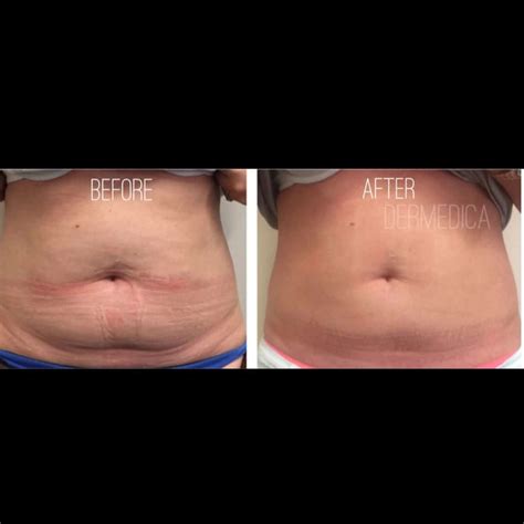 Stomach Before And After Hysterectomy