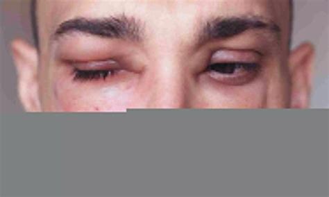 Donidalorsen reduces rate of angioedema attacks in patients with ...