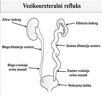 Urinarne infekcije kod dece | Urinary Tract Infection in Children - UTI ...