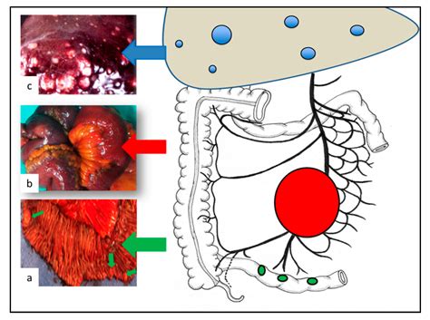 Surgery and Perioperative Management in Small Intestinal Neuroendocrine Tumors