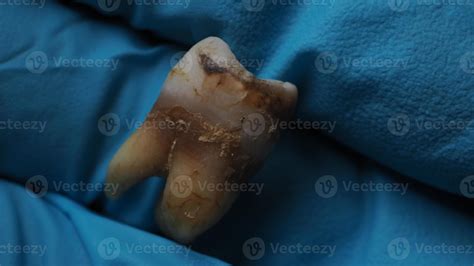 Decayed Tooth Pulling 的图像结果