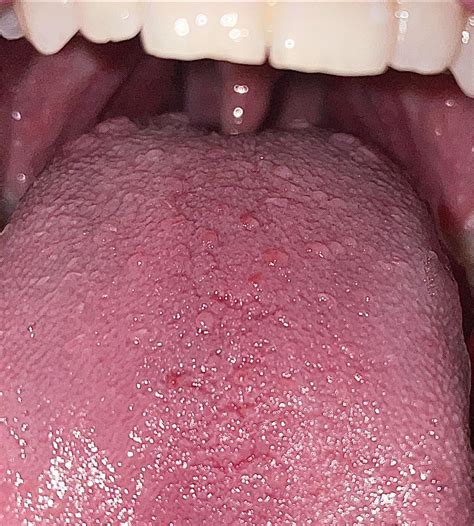 What are these bumps on the back of my tongue? : u/1177throwaway117