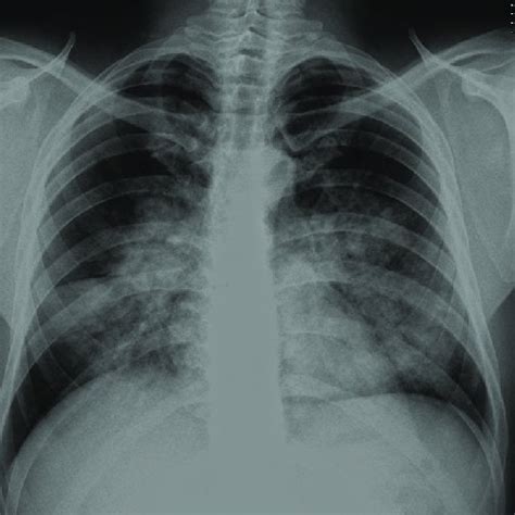 Hospital X-ray Chest 的图像结果
