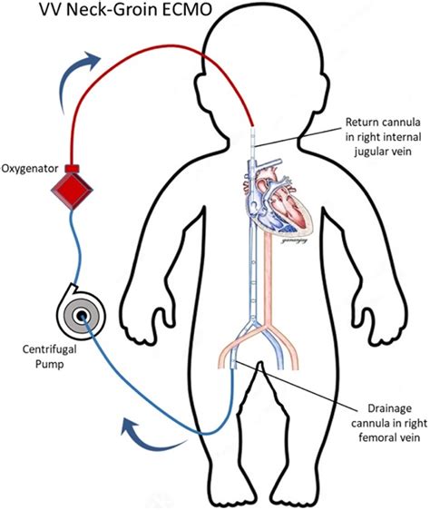 Extracorporeal membrane oxygenation in children: A brief review ...