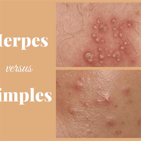 Herpes vs Pimple: Key Differences, Symptoms, Pictures Guide and Treatment