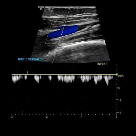 Upper Arm Vein Ultrasound at Tracey Parmelee blog