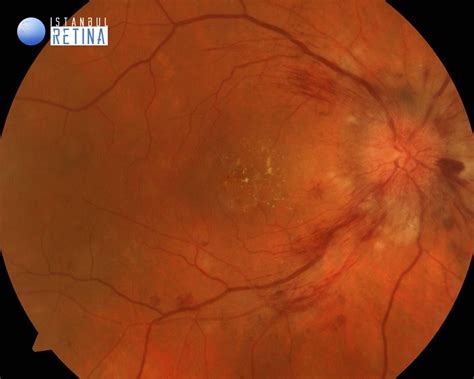 What Is Av Nicking at Carlos Mcclellan blog