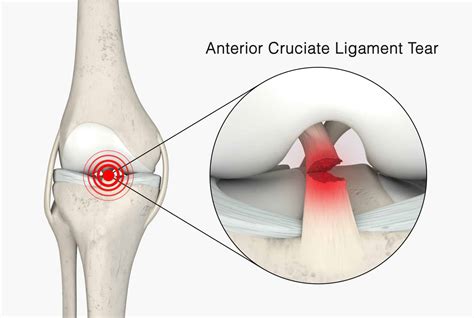 ACL INJURIES: Prevention, Treatment and Recovery