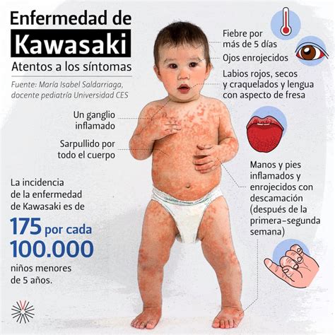 Enfermedad De Kawasaki