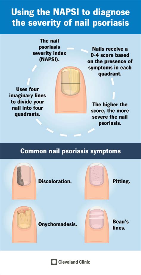 Nail Psoriasis: What It Is, Causes, Nail Pitting, Treatment