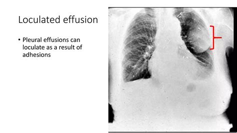 Loculated Pleural Effusion
