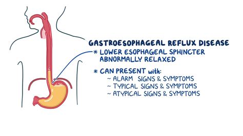 Diagnosing gastroesophageal reflux disease – gastroösophageale ...