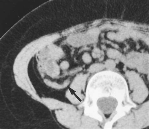 Unenhanced Limited CT of the Abdomen in the Diagnosis of Appendicitis in Children Comparison ...