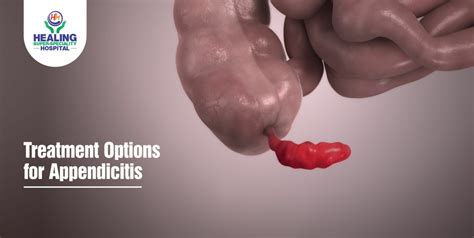 Treatment Options for Appendicitis - Healing Hospital