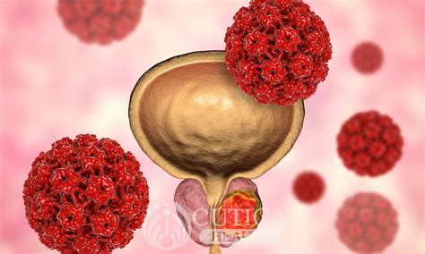 Prostate Cancer 的图像结果