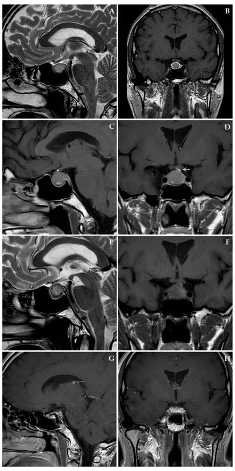 Pituitary Apoplexy in a Non-Functioning PitNET After Cabergoline Use ...