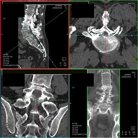 Degenerative Joint Disease (DJD) of Lumbar Spine - Musculoskeletal ...