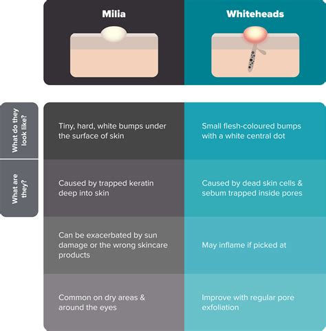 What are milia and how to remove them | Paula's Choice