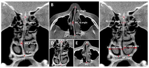 A CBCT Evaluation of Nasal Septal Deviation and Related Nasofacial Structures after Maxillary ...