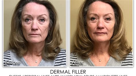 40 DERMAL FILLER CHEEKS, PERIORAL, LIP, NASOLABIAL FOLD, MARIONETTE - Skin Rejuvenation Clinic ...