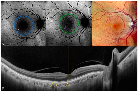 Blue Light and Green Light Fundus Autofluorescence, Complementary to Optical Coherence ...