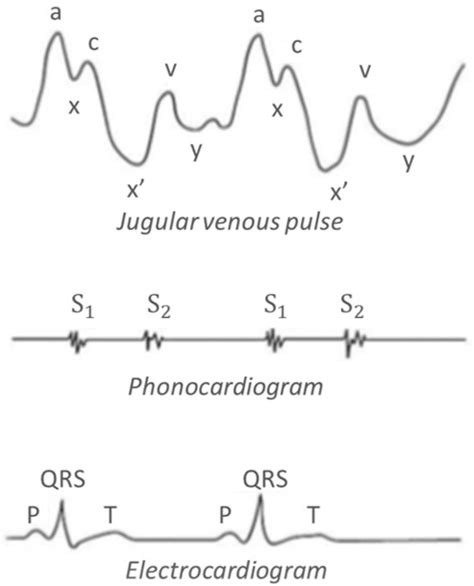 Carotid Vs Jugular Pulse