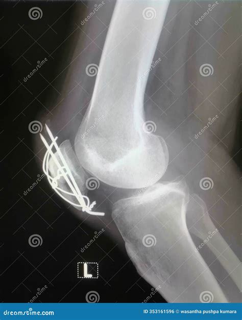 Patella Fracture: Types, Causes And Treatment – OVPAJR