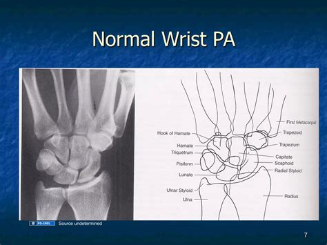 GEMC: Radiology: X-rays of the Hand and Wrist: Resident Training | PDF