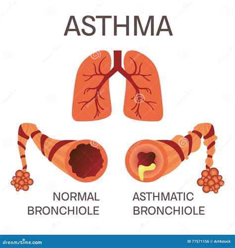 Asthmatic Bronchitis Vs Bronchitis at Greg Booth blog