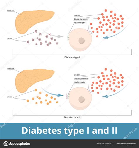 Diagrama De Diabetes Tipo 2