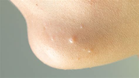Molluscum Contagiosum Treatment | Wellesley Dermatology