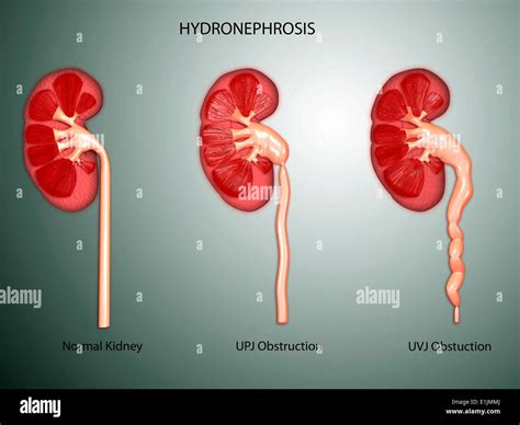 Hydronephrosis condition of the kidney Stock Photo - Alamy