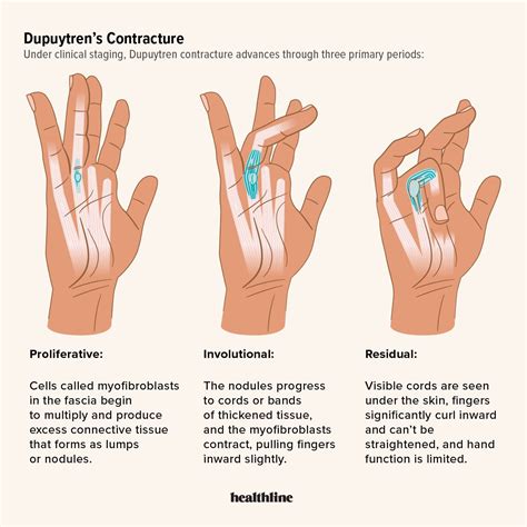 Dupuytren's Contracture Icd 10