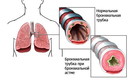 Бронхиальная астма: группа риска, причины и симптомы заболевания ...
